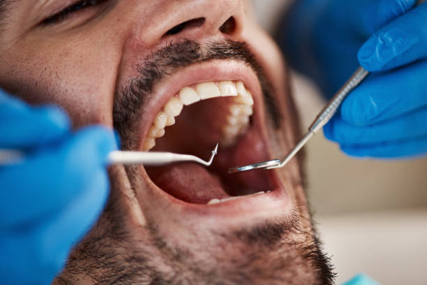 Best Emergency Dentist for Lost Fillings or Crowns in Freemansburg, PA